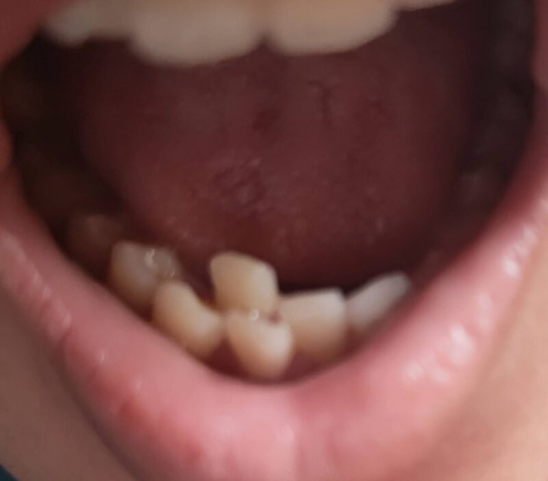 実際の歯の様子
